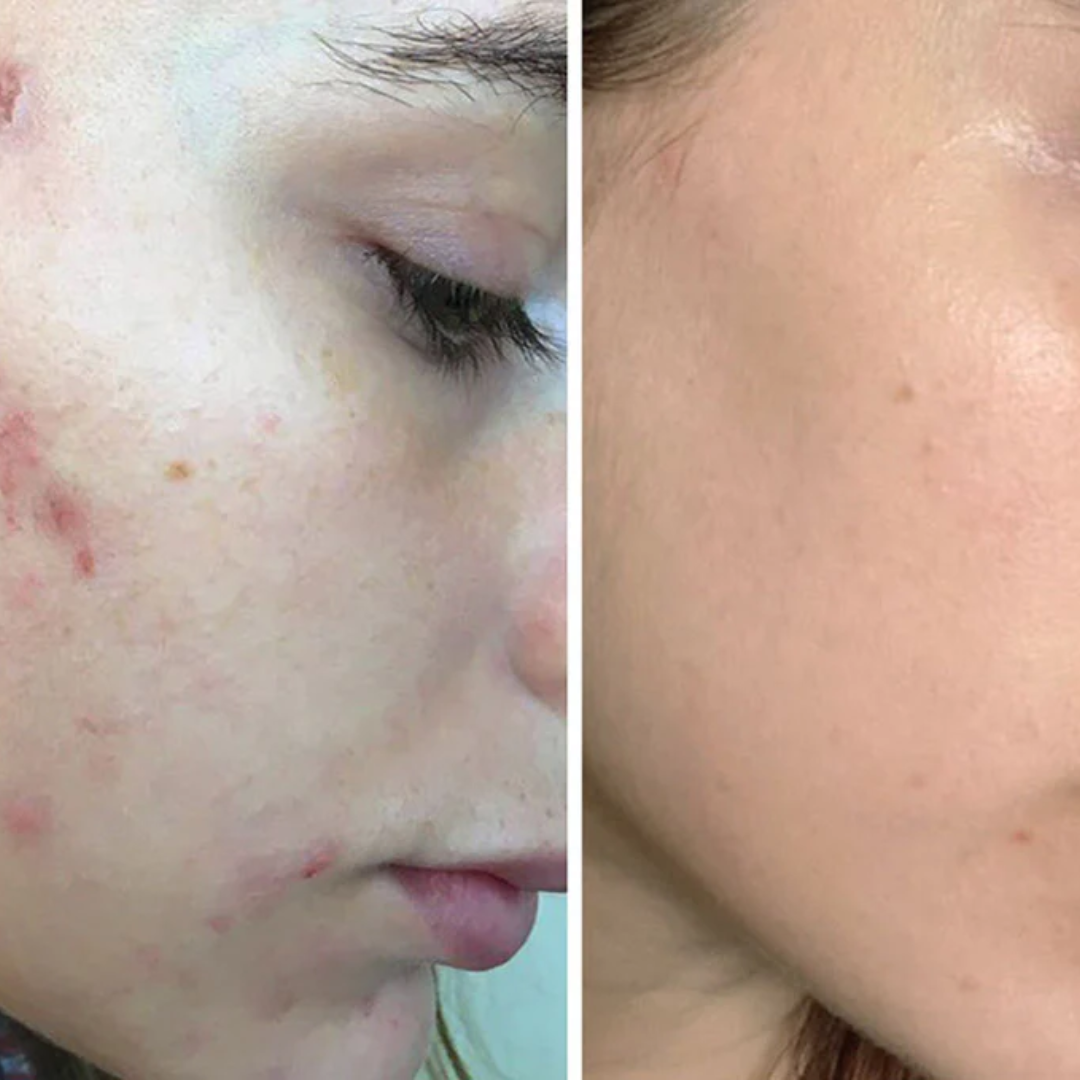 Laniska Scar Soothing Cream | 7-in-1 Skin Repair with Argan Oil